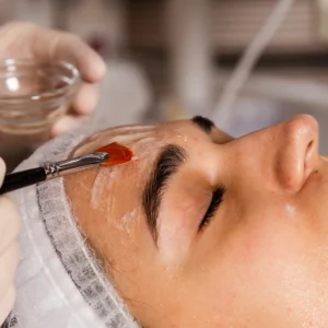 Chemical Peel and Microneedling Combo Facial